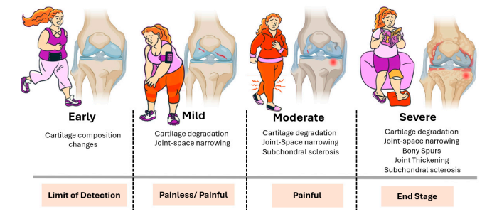 https://ostizeel.com/wp-content/uploads/2025/07/Osteoarthritis-phases.png